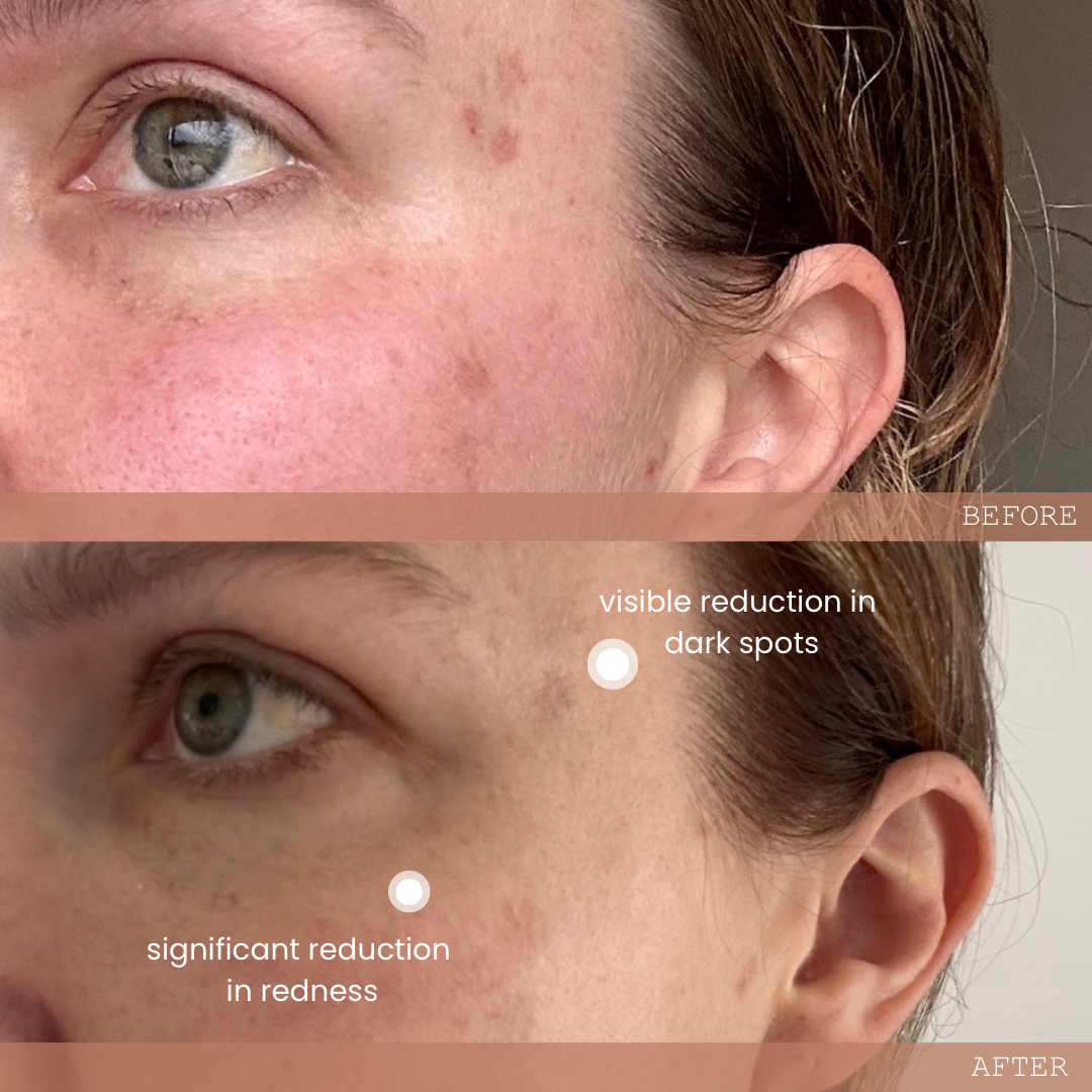 ECLIPSE DUO | A DAY & NIGHT TREATMENT
