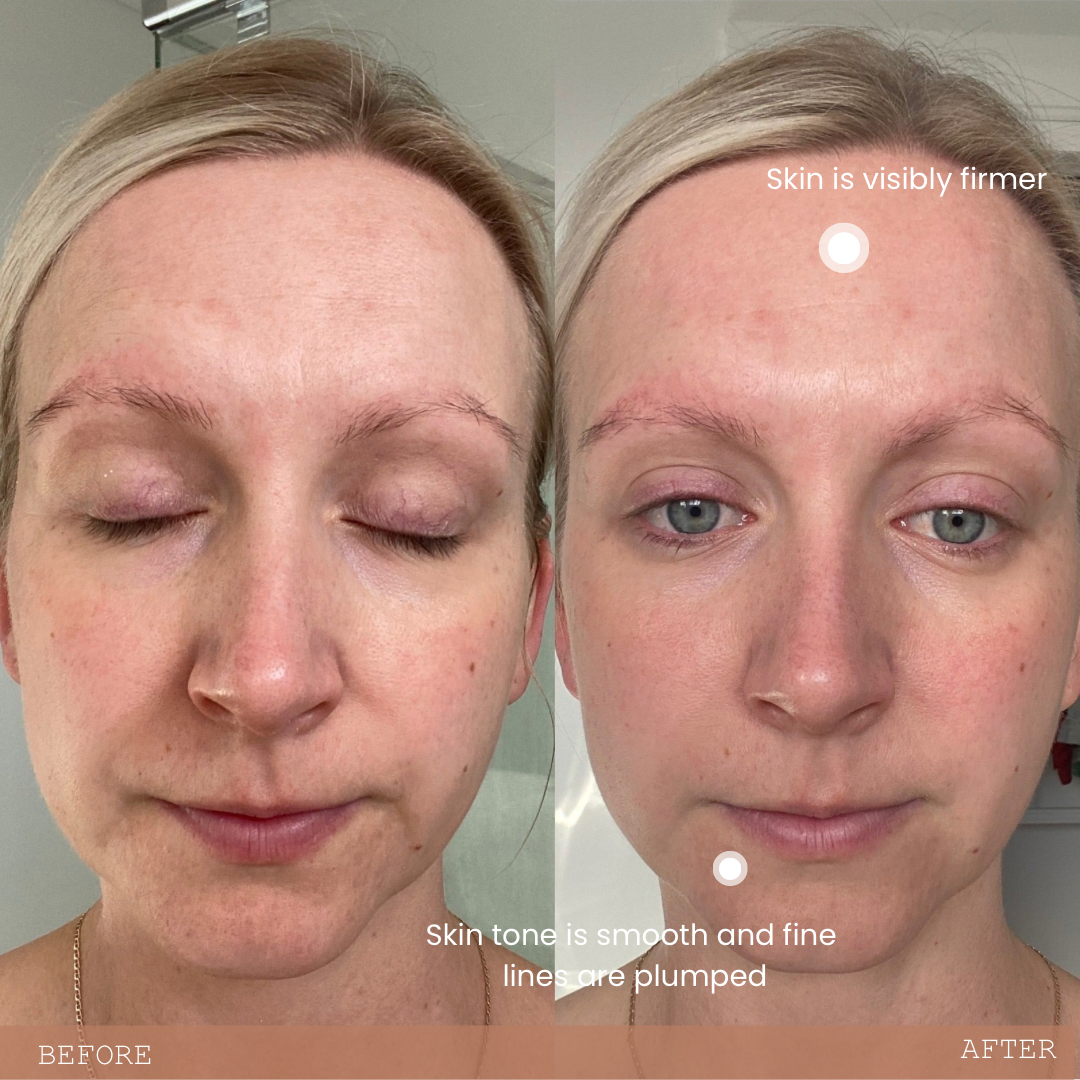 Before and after photos of mother using Biomama Skincare during pregnancy.  Image 2 (after photo) shows a visible change in the texture and tone of the skin.  Fine lines are smoothed and skin is firmer.  There s visible evidence of overall clarity.
