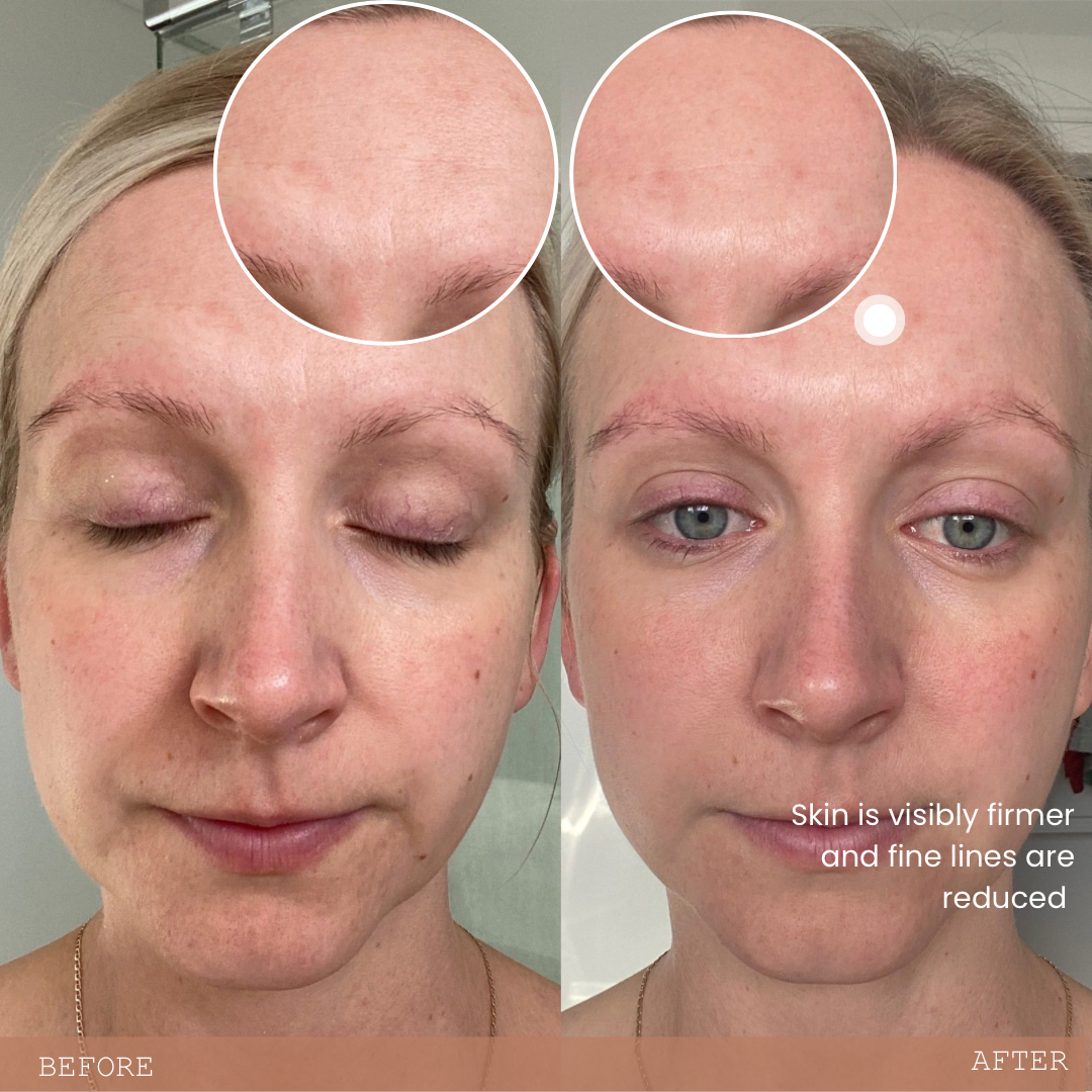 Before and after photos using Biomama Skincare - face care for pregnancy and postpartum 