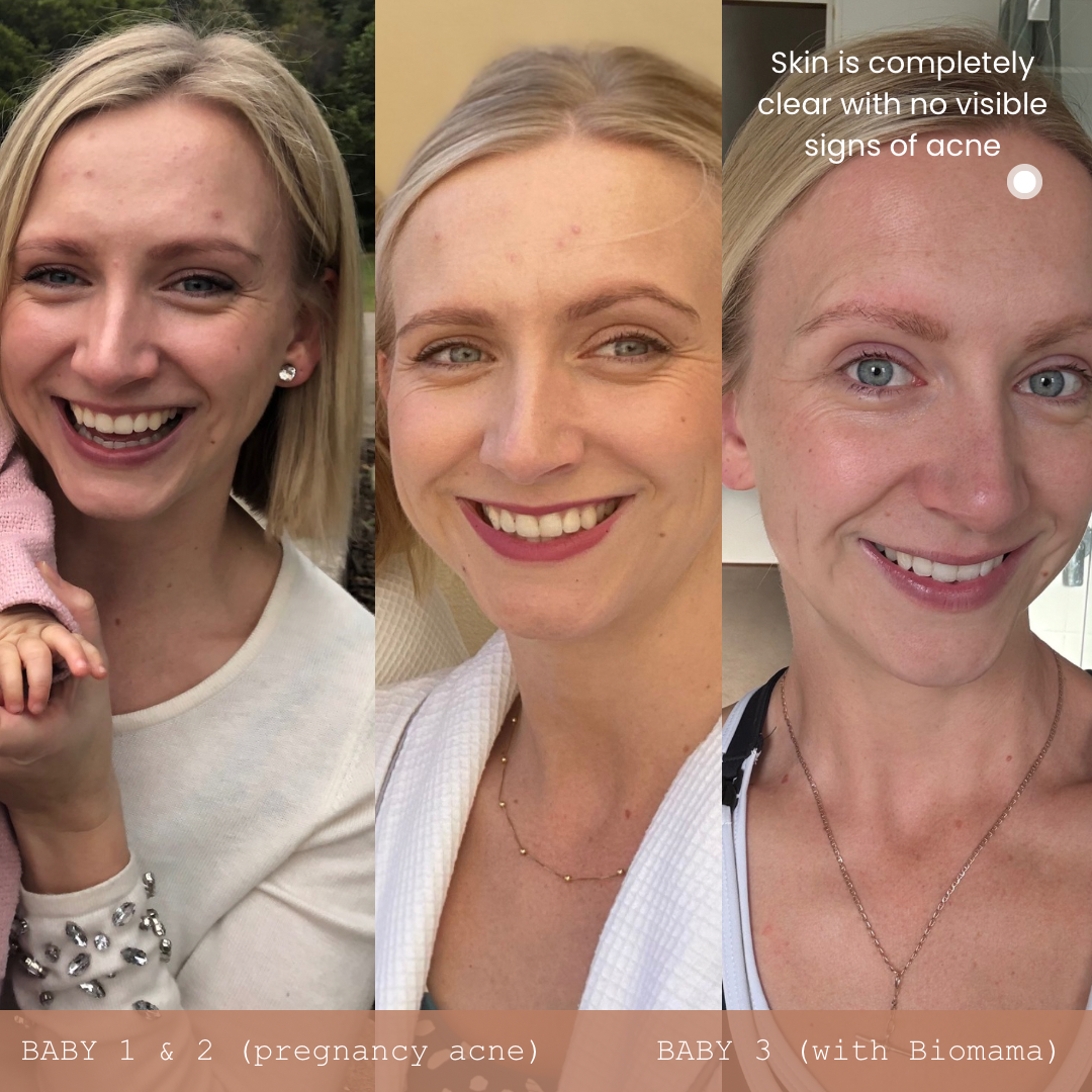 Before and after photos of woman with acne during 1st and 2nd pregnancy.  Image 3 shows no acne with daily use of Biomama Awakening Cleanser